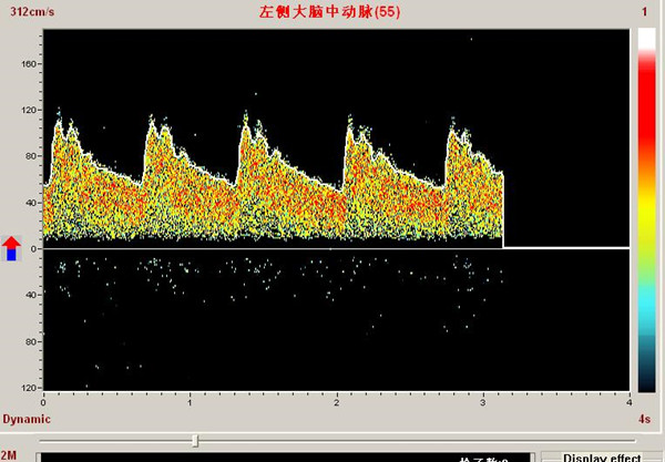 經顱多普勒PW模式下單窗口檢測頻譜 經顱多普勒PW模式下單窗口檢測頻譜
