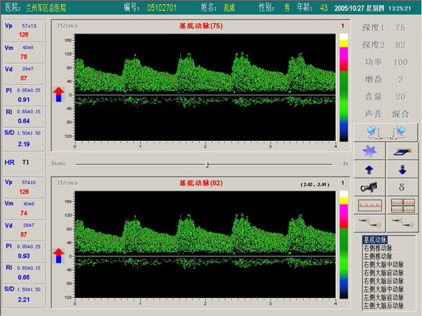 1533193056890208.jpg 超聲經(jīng)顱多普勒血流分析儀雙窗口(雙通道或雙深度)檢測(cè)界面.jpg