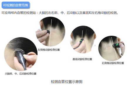 腦彩超儀(TCD儀)的檢測范圍 腦彩超儀(TCD儀)的檢測范圍