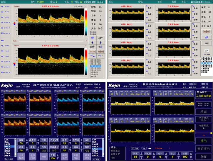TCD血管定位技術實現自動搜索血管信號 TCD血管定位技術實現自動搜索血管信號