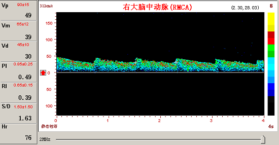 KJ系列超聲經顱多普勒腦動脈瘤頻譜圖 KJ系列超聲經顱多普勒腦動脈瘤頻譜圖