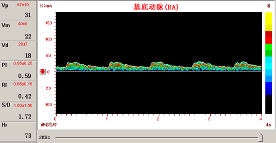 經顱多普勒對椎─基底動脈的 經顱多普勒對椎─基底動脈的