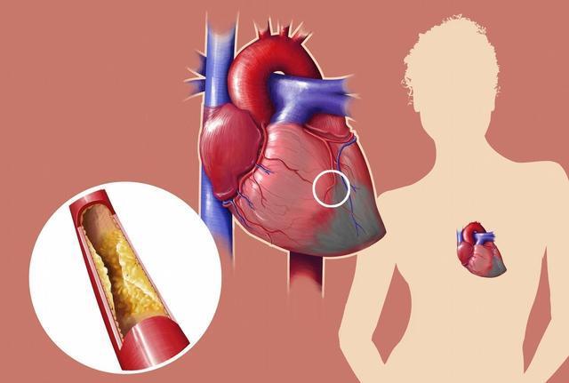 高血脂究是如何引發(fā)腦血管疾病的 高血脂究是如何引發(fā)腦血管疾病的