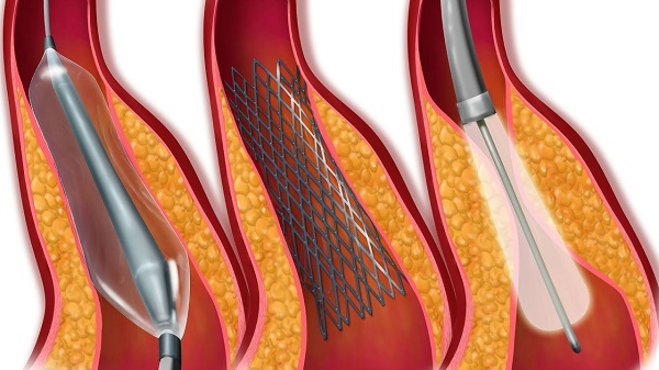 哪些檢查方法可以發(fā)現(xiàn)腦動脈狹窄 哪些檢查方法可以發(fā)現(xiàn)腦動脈狹窄