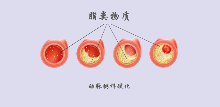 顱內(nèi)動脈粥樣硬化與缺血性腦卒中的關(guān)系 顱內(nèi)動脈粥樣硬化與缺血性腦卒中的關(guān)系